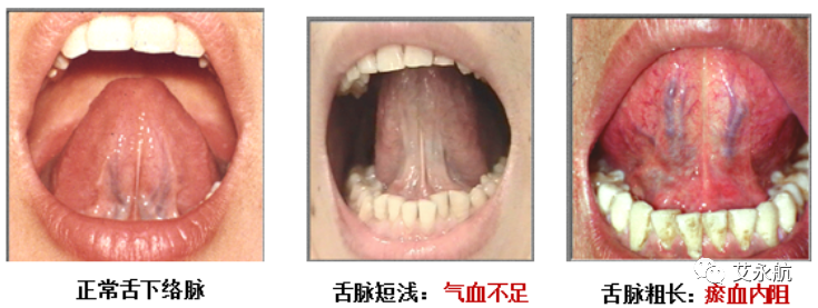 Understanding Disease Through Tongue Diagnosis in Traditional Chinese Medicine