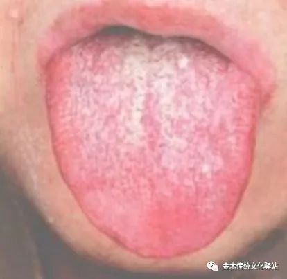 Tongue Diagnosis in Traditional Chinese Medicine: Characteristics of Tongue Coating