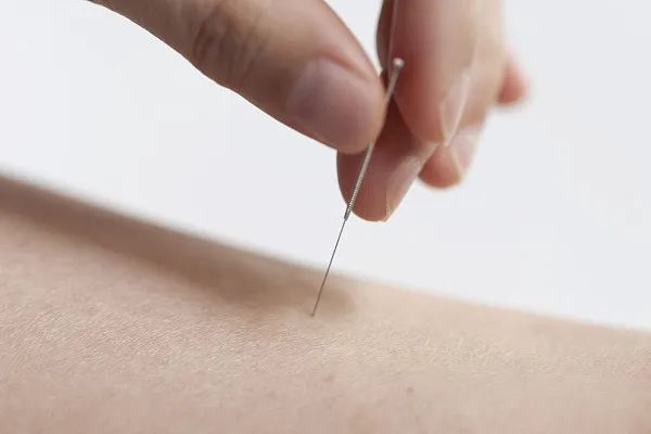 Traditional Chinese Medicine Techniques: The Efficacy of Fine Needle Acupuncture