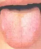 Comprehensive Guide to Tongue Diagnosis: Learn How Your Tongue Reflects Your Health!