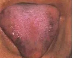 Understanding Tongue Diagnosis in Traditional Chinese Medicine (with Tongue Diagnosis Illustrations)