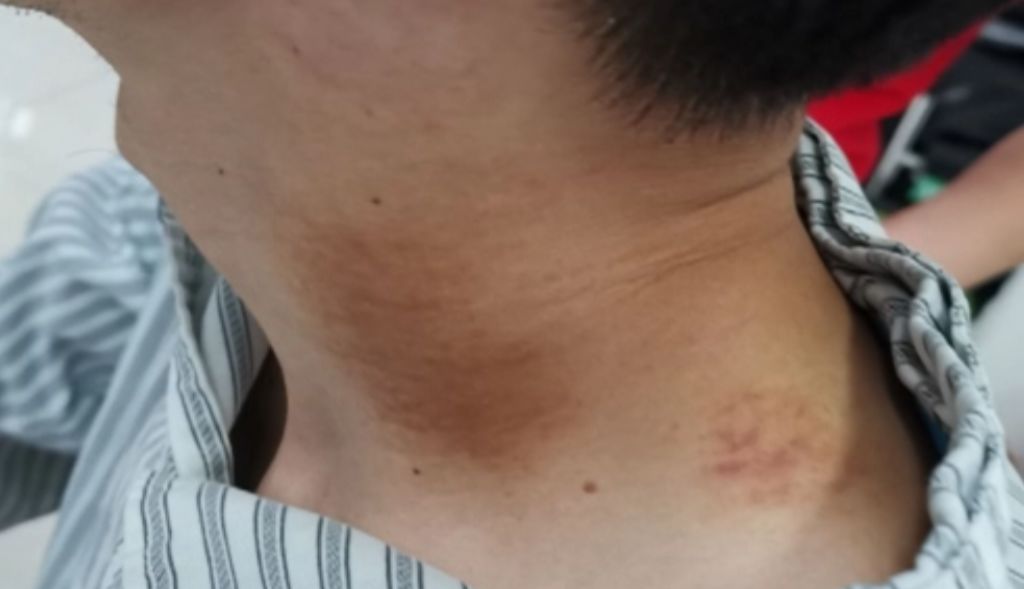 Man Suffers Stroke After Massage and Gua Sha at Home; This Area Should Not Be Massaged Casually