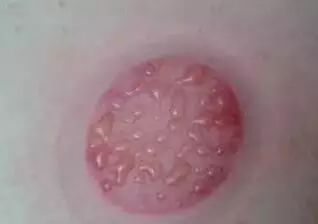 A Comprehensive Guide to Cupping Therapy