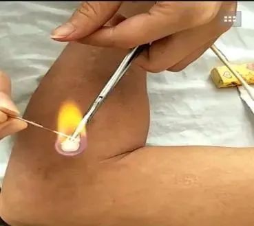 Acupuncture Department II: What Conditions Can Fire Needle Therapy Treat?