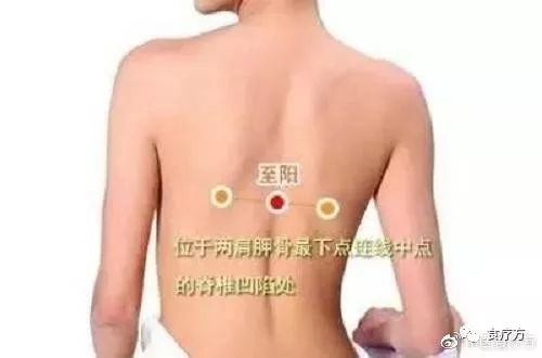 Comprehensive Guide to Cupping Therapy for the Back