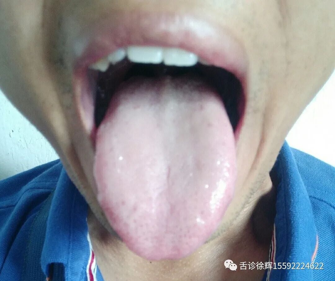 Analysis of Tongue Appearance: Discussing the Reasons for Variations in Tongue Shape and Color at Different Times