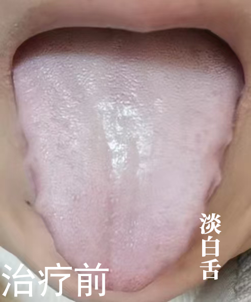 The Body Signals Illness: Understanding Tongue Diagnosis in TCM