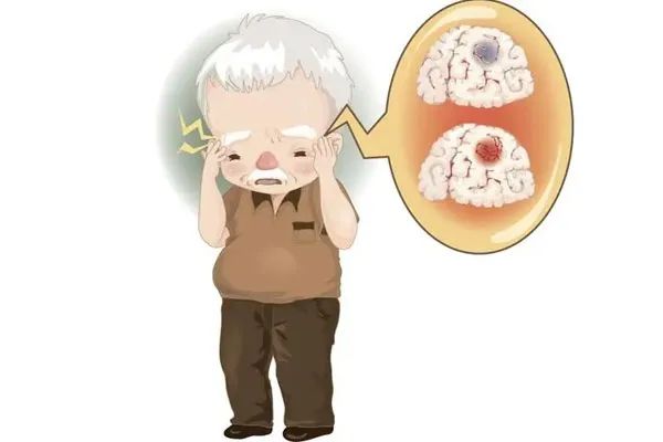 Observing the Tongue in Traditional Chinese Medicine: Tongue Color Changes Indicate Stroke!