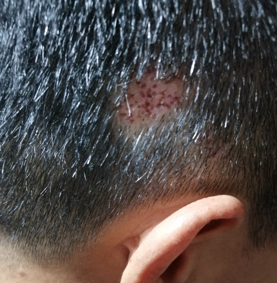 The Treasure of TCM in Treating Alopecia Areata