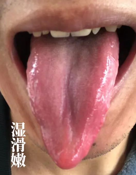 The Body Signals Illness: Understanding Tongue Diagnosis in TCM