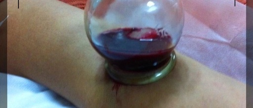 The Wonders of Bloodletting Therapy in Traditional Chinese Medicine