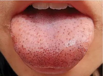 Blood Stasis and Its Impact on Health: How to Care for Individuals with Blood Stasis Constitution