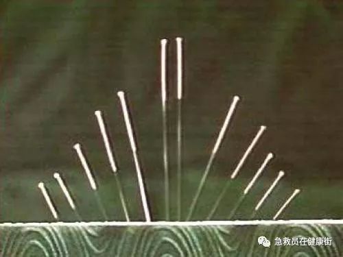 Filiform Needles in Traditional Chinese Medicine