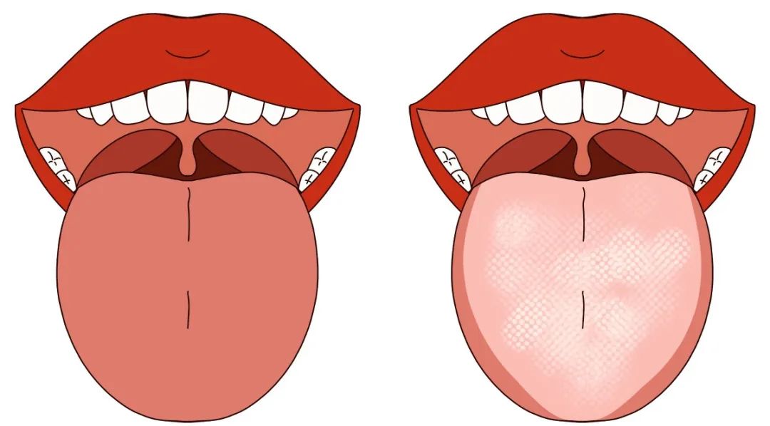 The Tongue as a Reflection of Health: A Quick Self-Check!