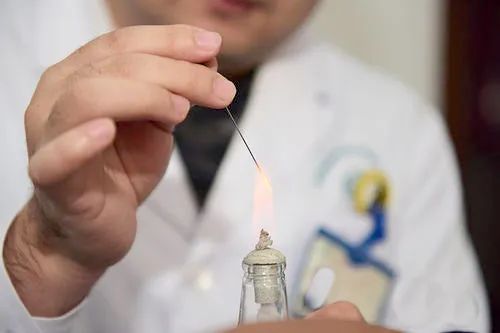 Fire Needle: An Evolution in Acupuncture Therapy