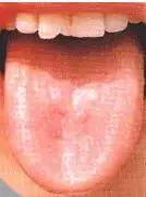 Comprehensive Guide to Tongue Diagnosis: Easily Understand Your Health Condition