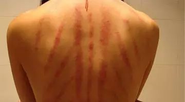 Is the Sha and Bruise from Gua Sha the Same? Is Gua Sha Difficult to Learn?