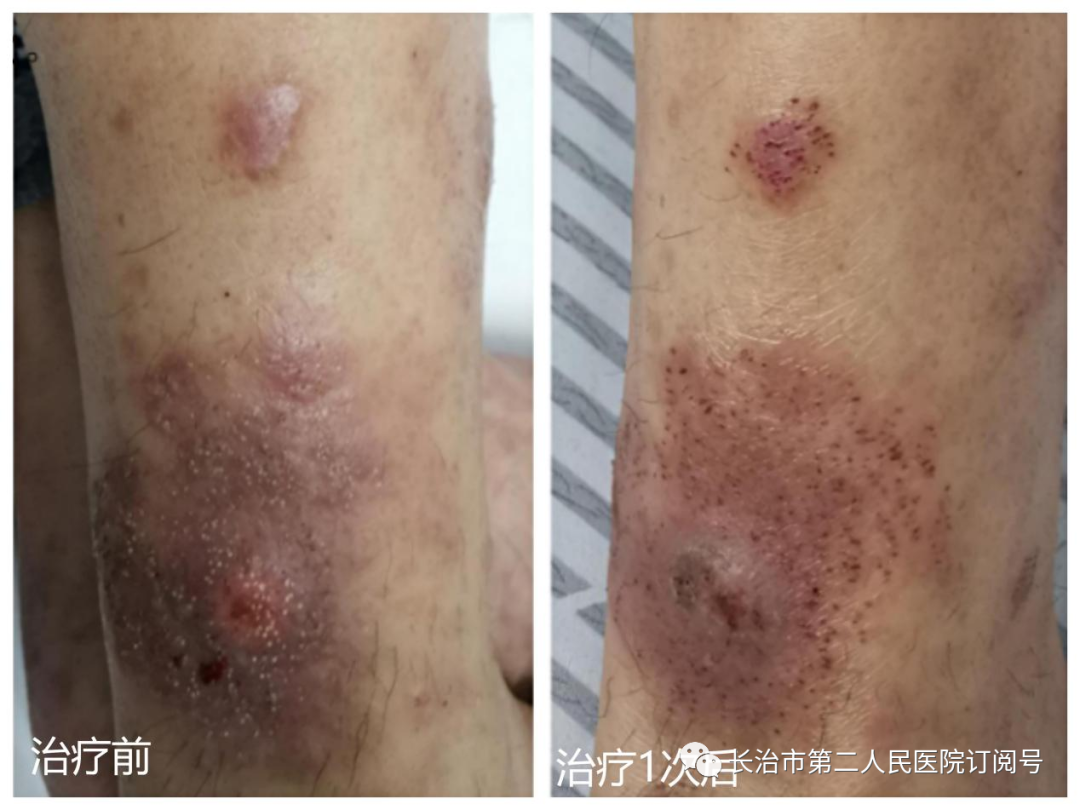 The Power of Fire Needling in Treating Skin Diseases