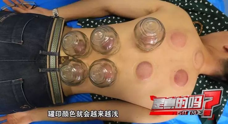 What Does the Color of Bruises After Cupping Therapy Indicate?