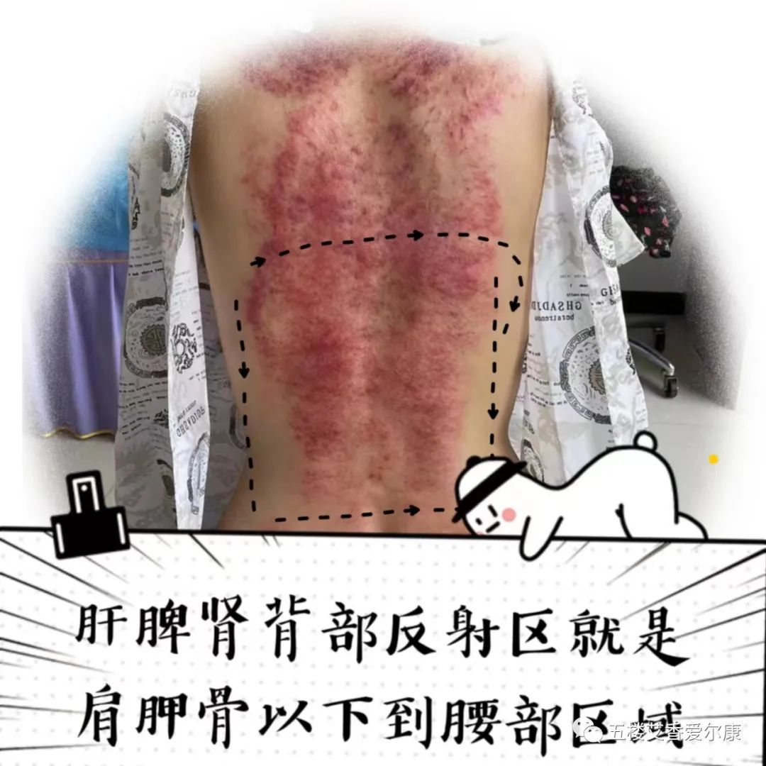 Summary of Common Diseases and Gua Sha Treatment Plans Including Human Reflex Maps, Contraindications, and Diagnosis of Sha Patterns