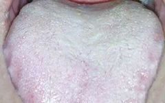 Four Tongue Coating Colors Revealing Your Body Condition