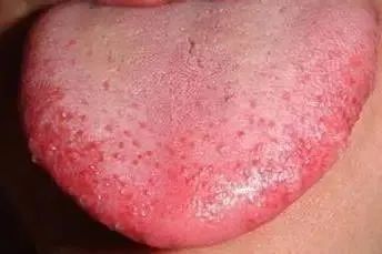 How to Observe Tongue Coating to Reflect Your Health