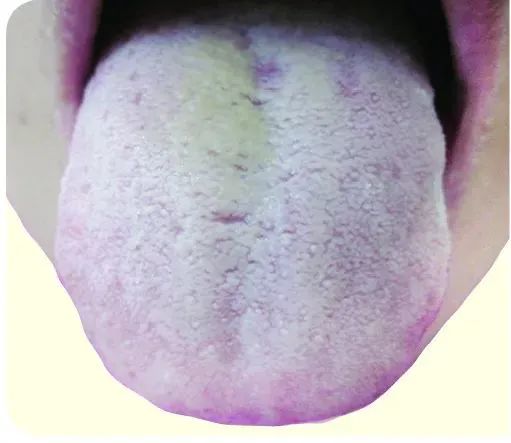 How to Observe Tongue Coating to Reflect Your Health