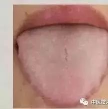 Tongue Diagnosis: Issues Revealed and Simple TCM Remedies