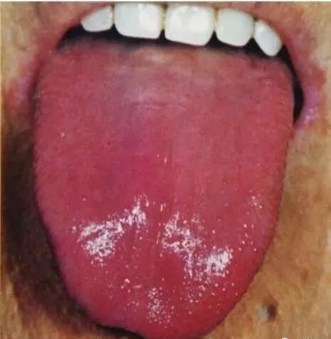 Comprehensive Guide to Tongue Diagnosis and Associated Conditions in TCM