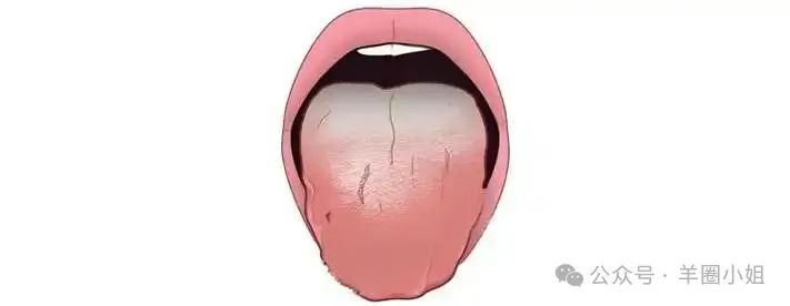 Is a Thick Coating on the Tongue Your Body's Alarm? A Practical Guide to Understanding Tongue Coating