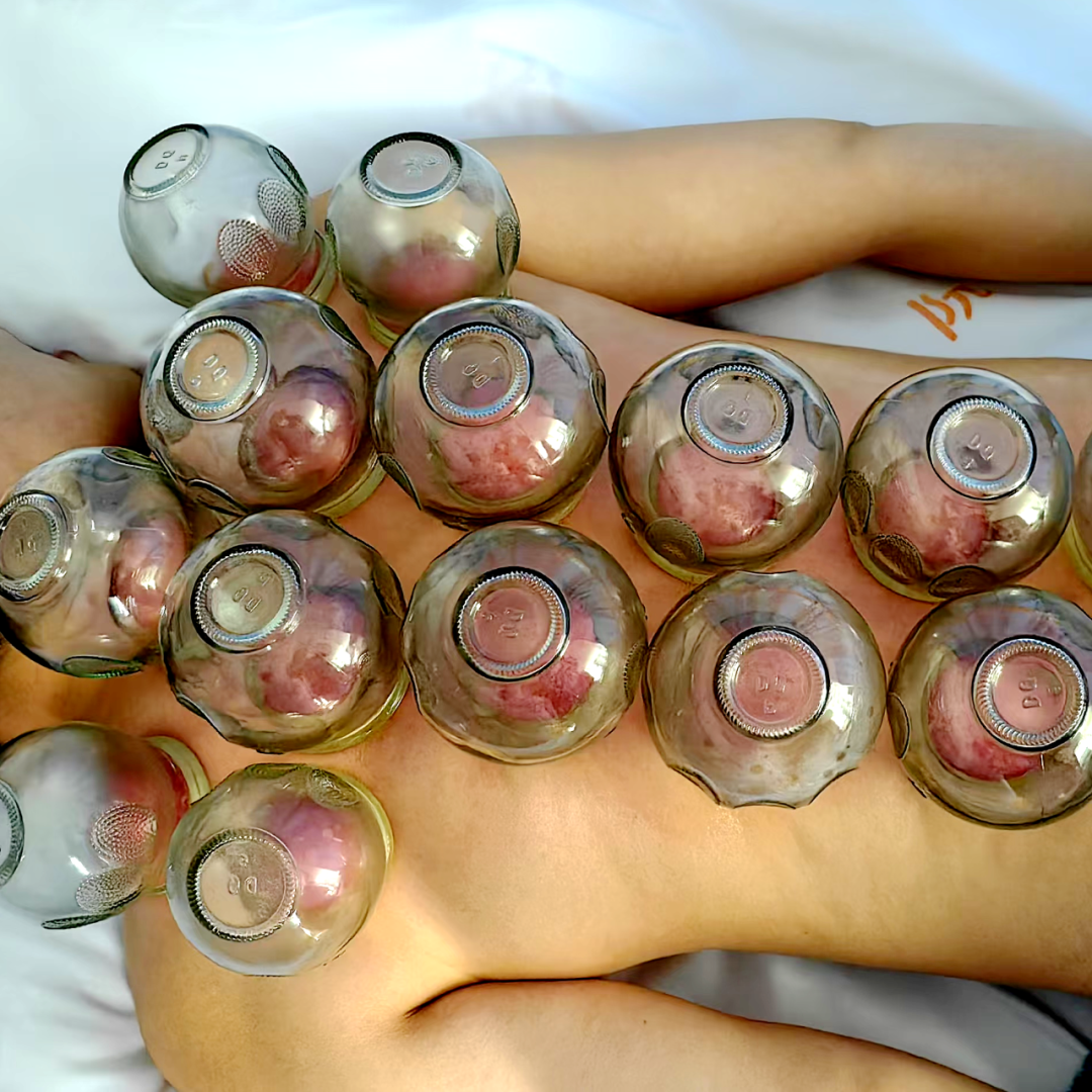 Balancing Cupping Therapy: Aiding Recovery for Cerebrovascular Disease Patients