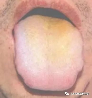 Tongue Diagnosis in Traditional Chinese Medicine: Tongue Coating