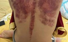 Summary of Common Diseases and Gua Sha Treatment Plans Including Human Reflex Maps, Contraindications, and Diagnosis of Sha Patterns