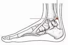 Fire Needle Therapy for Rheumatoid Arthritis