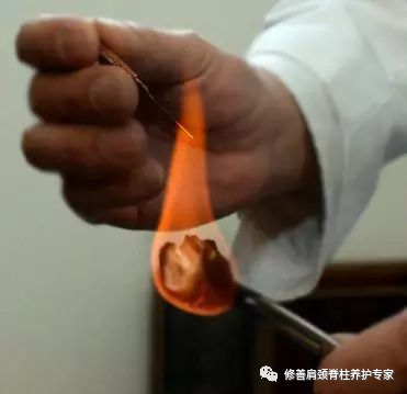 Fire Needle: An Evolution in Acupuncture Therapy