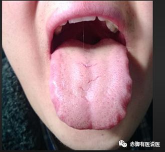 Understanding Your Tongue Diagnosis in 10 Minutes