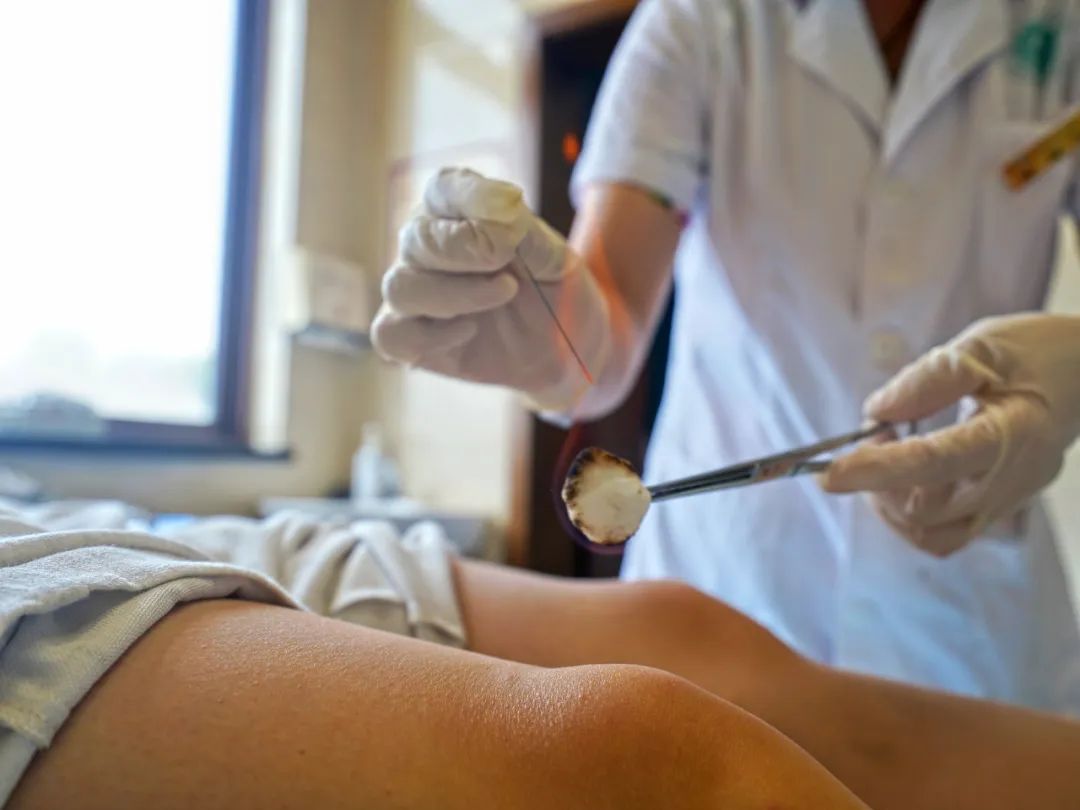 The Marvel of Fire Needle Therapy in Traditional Chinese Medicine