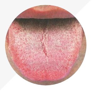 Understanding Tongue Diagnosis in TCM: Insights into Health from Tongue Appearance (Part 2)