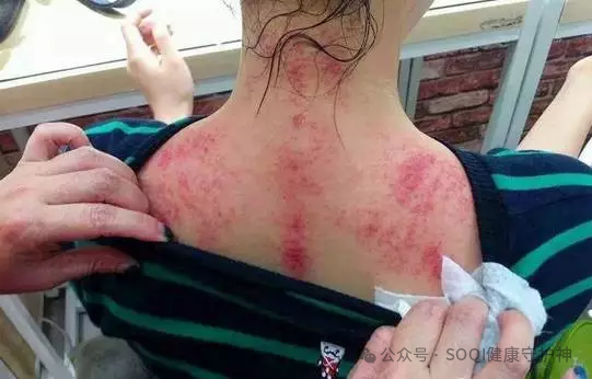 Why Should You Practice Gua Sha on the Neck and Shoulders? Can Regular Gua Sha on the Neck Combat Aging?
