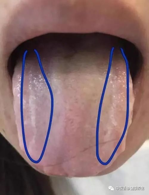 Nine Tongue Signs Indicating Qi Deficiency: Timely Adjustment and Medical Attention Recommended