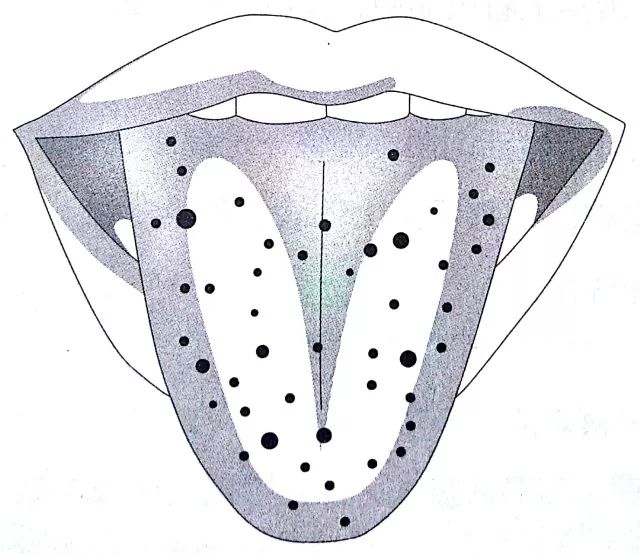 Understanding Health Through Tongue Diagnosis in Traditional Chinese Medicine