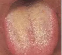 Understanding Tongue Diagnosis in Traditional Chinese Medicine (with Tongue Diagnosis Illustrations)