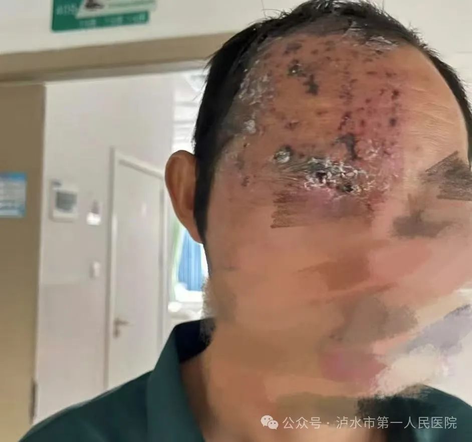 The Power of Small Needles: Lushui City First People's Hospital Implements Fire Needle and Bloodletting Cupping Therapy for Herpes Zoster