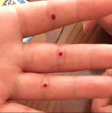 Utilizing the Four Seam Points for Bloodletting: Enhancing Appetite and Clearing Heat to Unblock Meridians