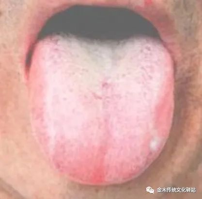 Tongue Diagnosis in Traditional Chinese Medicine: Characteristics of Tongue Coating