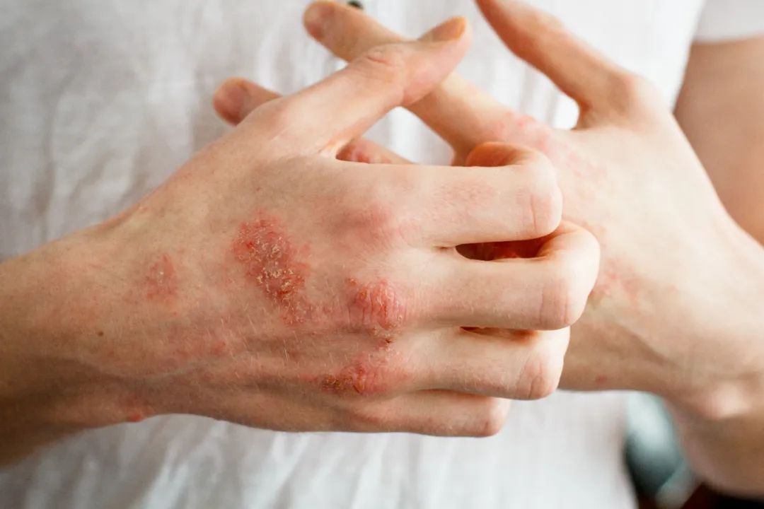 Health: Hot and Humid Weather Brings Eczema to Its Peak! Here Are Several Treatment and Management Methods to Keep Handy!