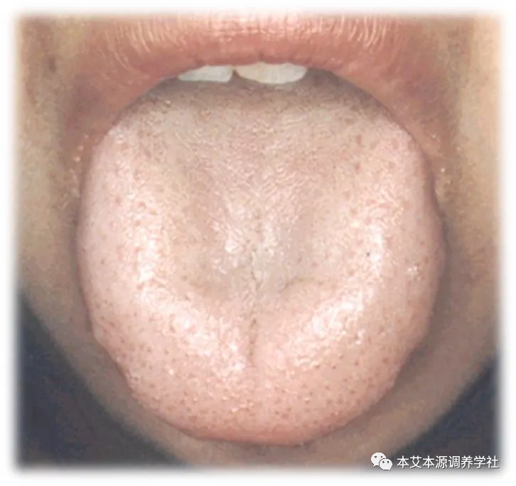 Tongue Diagnosis Series 3: Precise Differentiation of Tongue Coating, Quality, and Shape
