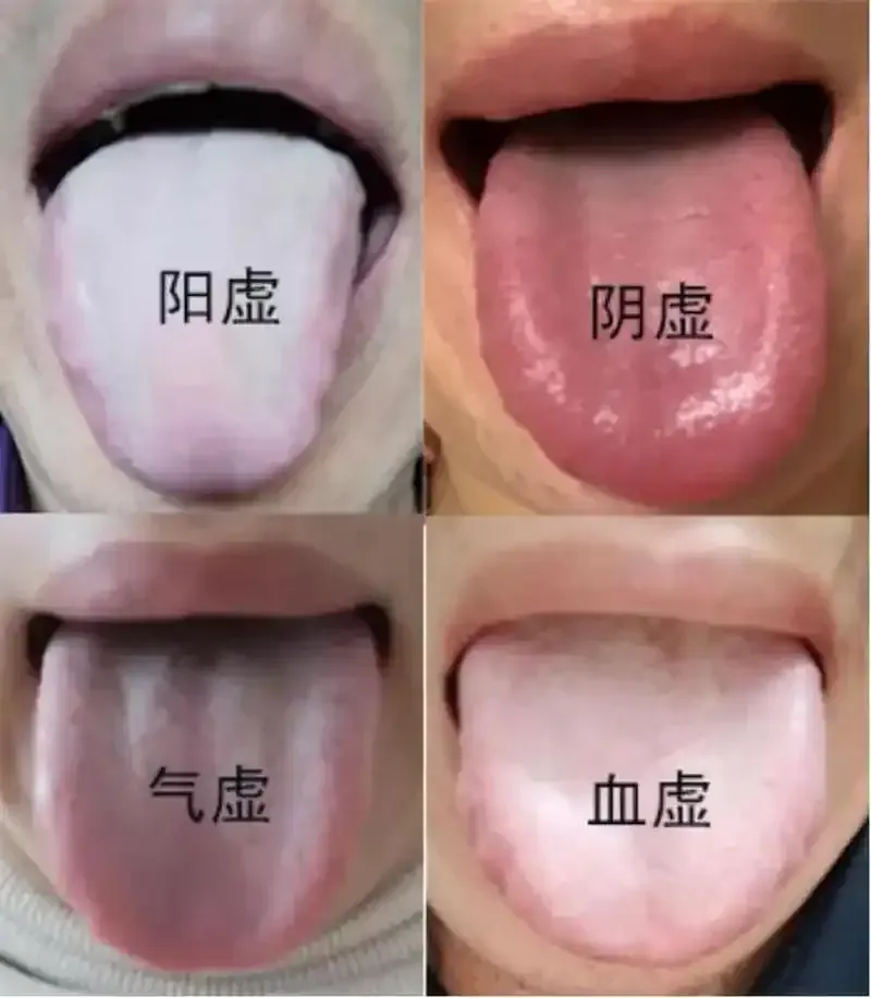 The Distinction Between Blood Deficiency and Yin Deficiency: Do Not Confuse Them!