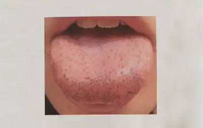 Exploring the Secrets of the Body Through Tongue Diagnosis