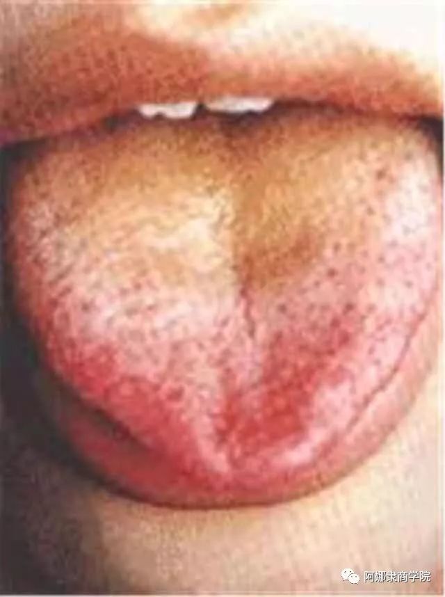 A Comprehensive Guide to 22 High-Definition Tongue Diagnosis Images: Understand Diseases Through Tongue Observation!